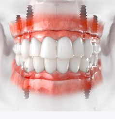 dental implants Adelaide