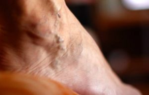 How Much is Varicose Vein Treatment Adelaide 